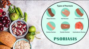 Psoriasis 